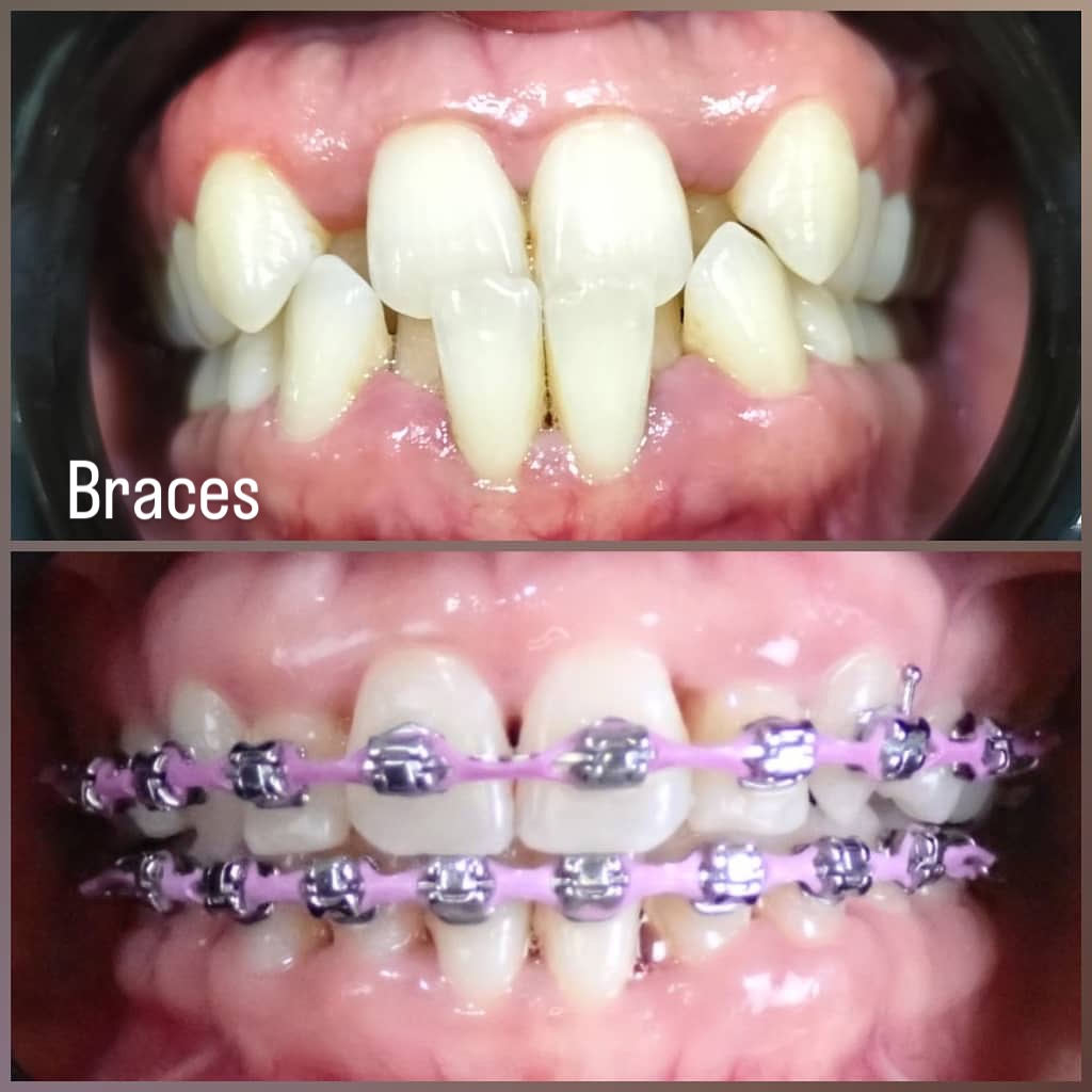 Rawatan Braces Dental