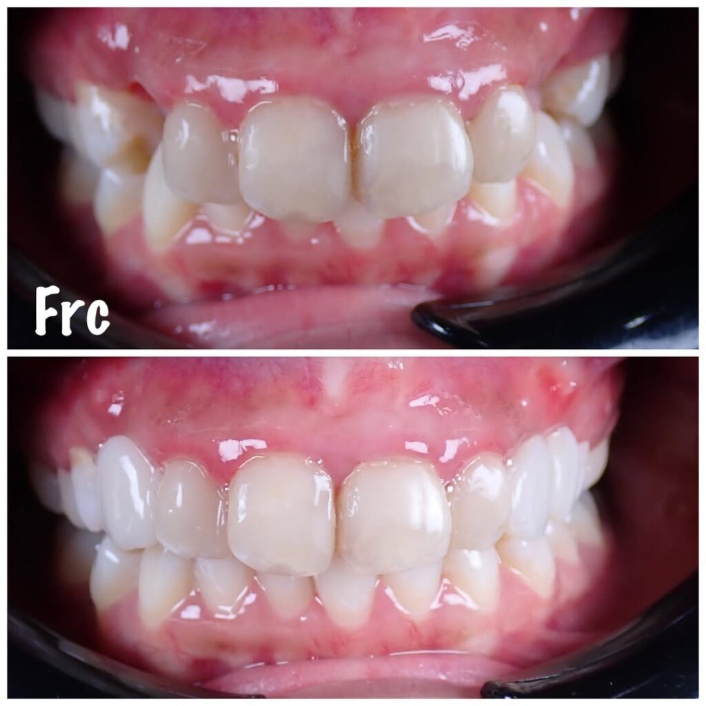 Rawatan FRC Dental