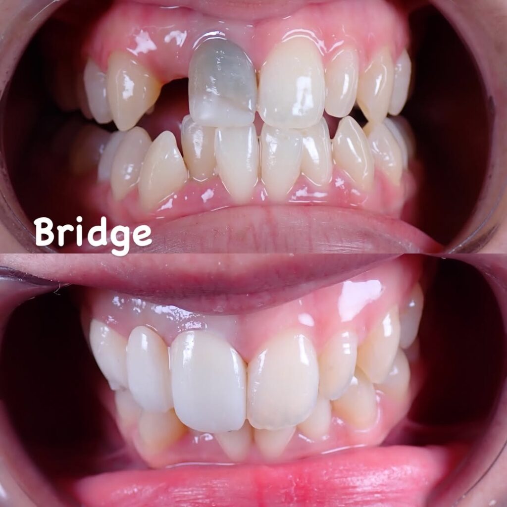 Rawatan Bridge Dental