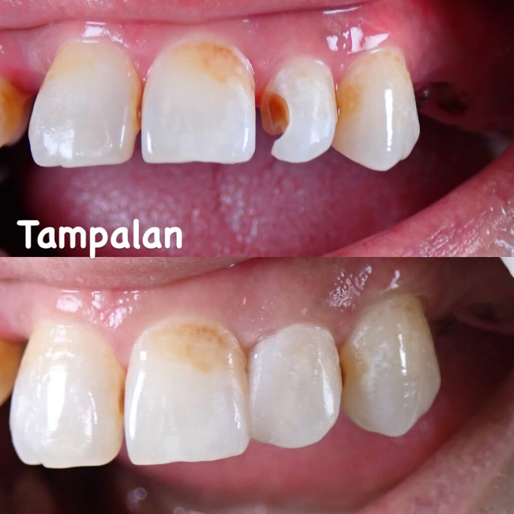 Tampalan filling dental